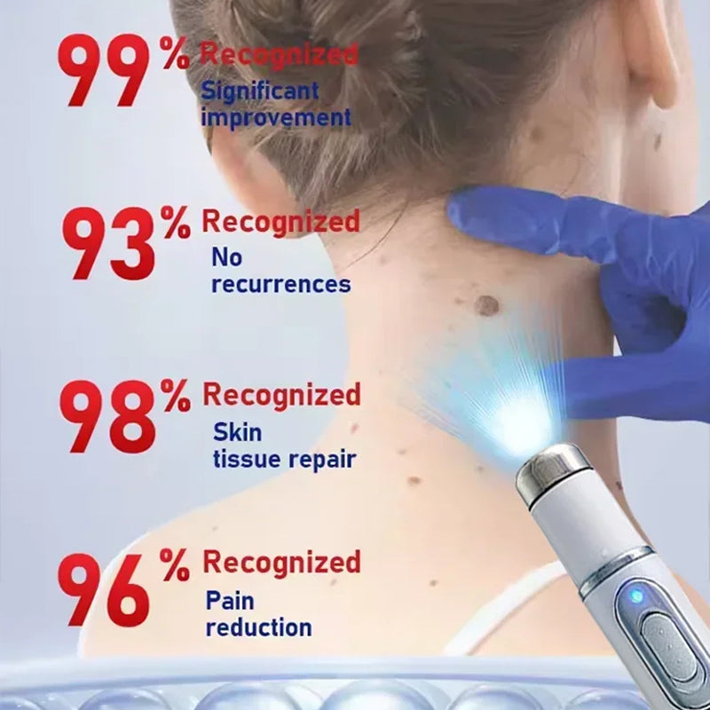 TalfMous Blue LED Light Therapy Wart Treatment