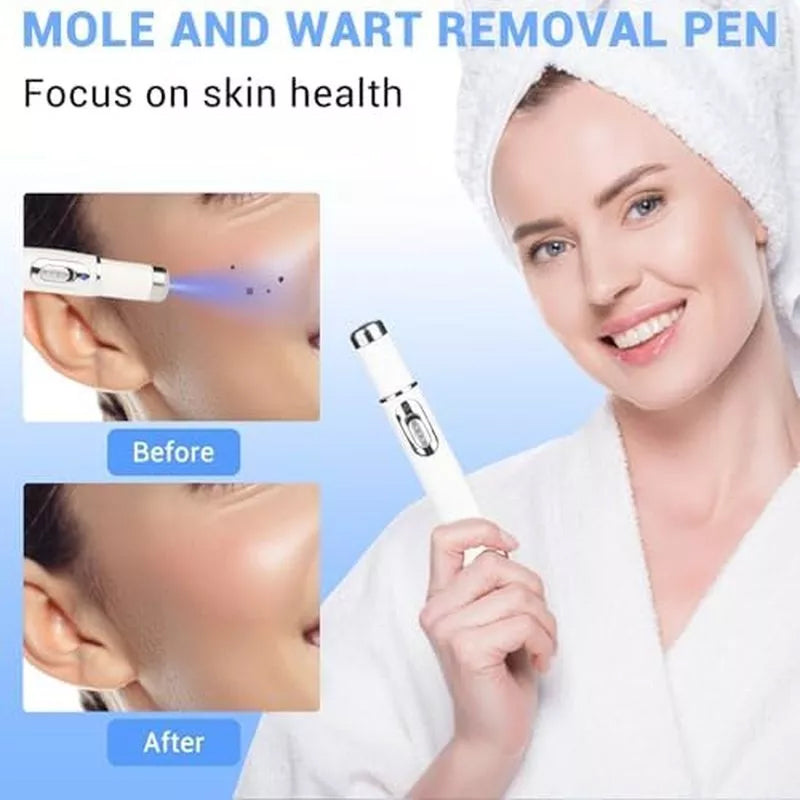 TalfMous Blue LED Light Therapy Wart Treatment