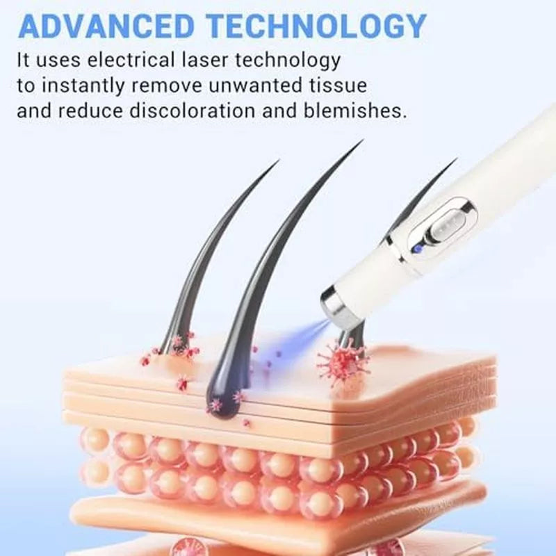 TalfMous Blue LED Light Therapy Wart Treatment