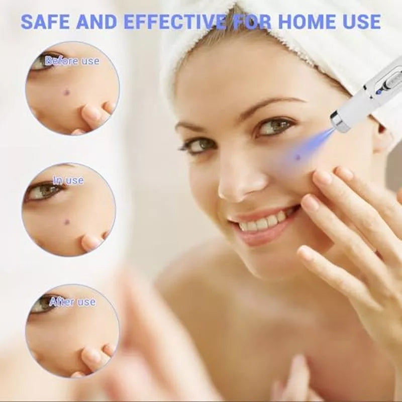TalfMous Blue LED Light Therapy Wart Treatment